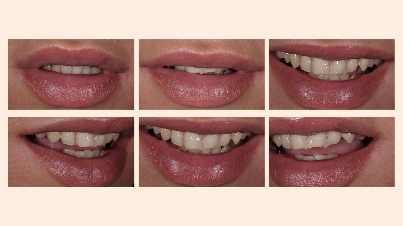 Kalotas-implants-before1