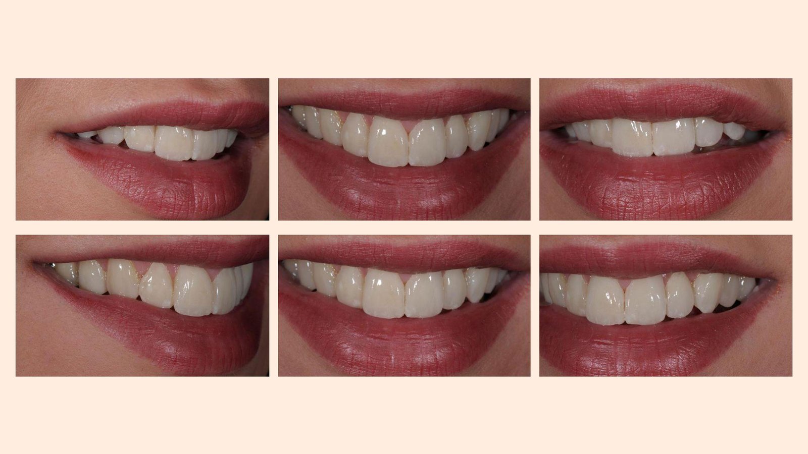 Kalotas-implants-before2