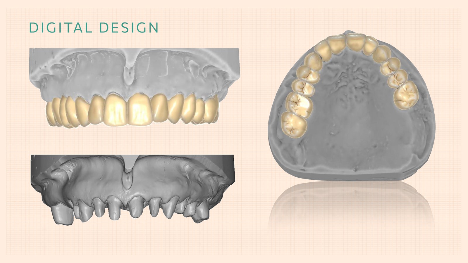 Kalotas-implants-DigitalDesign