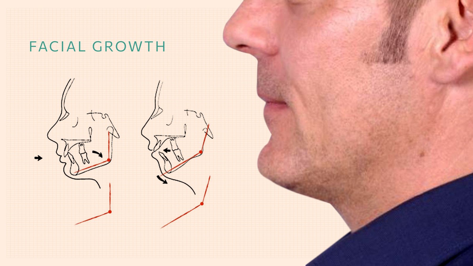 Kalotas-implants-Facial-upd