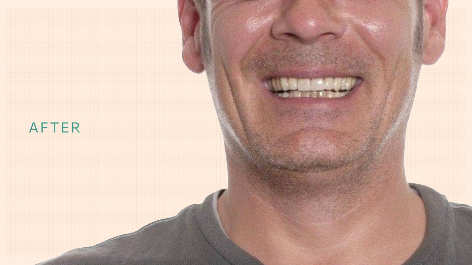 Kalotas-implants-after-upd