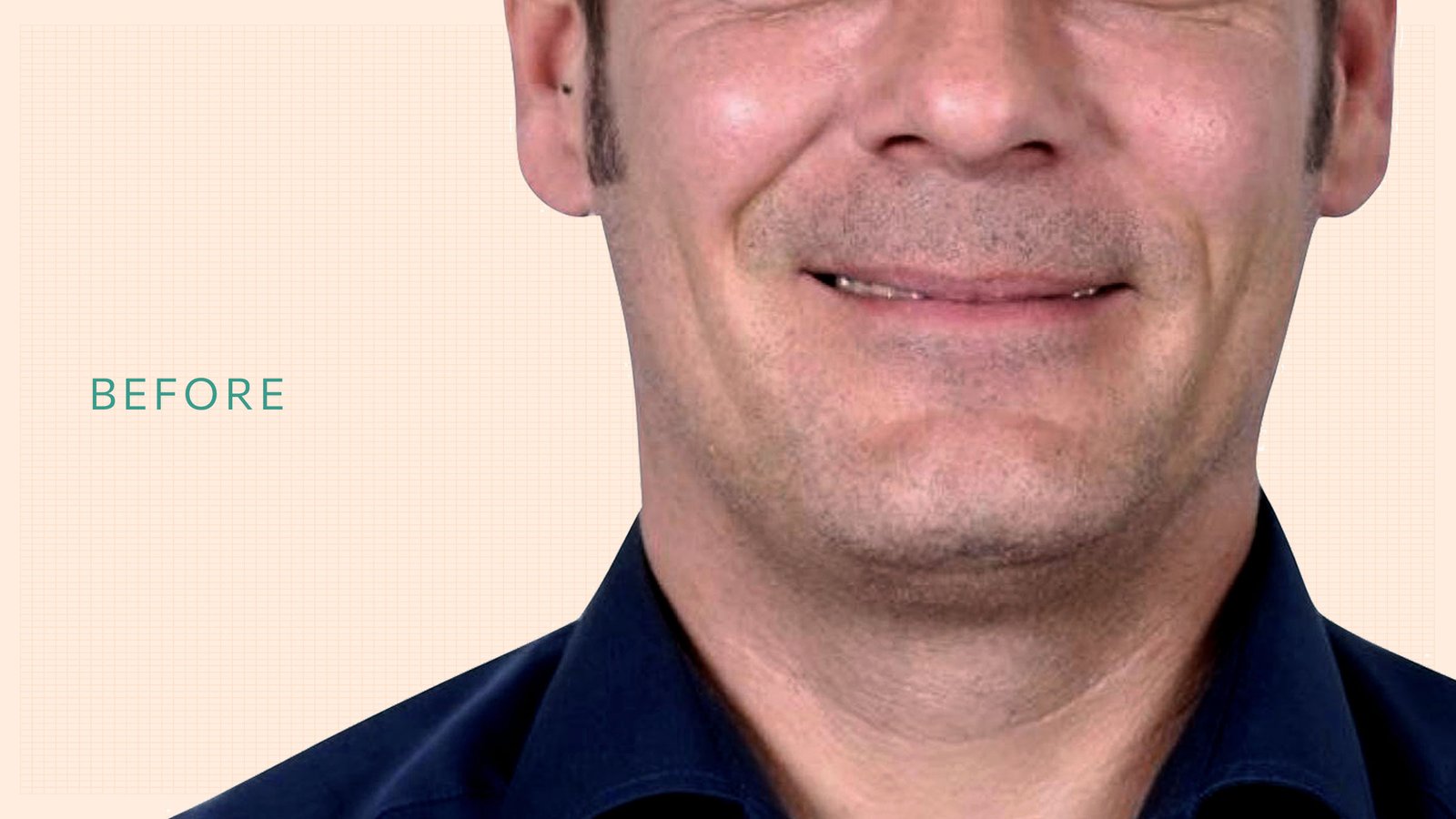 Kalotas-implants-before-upd